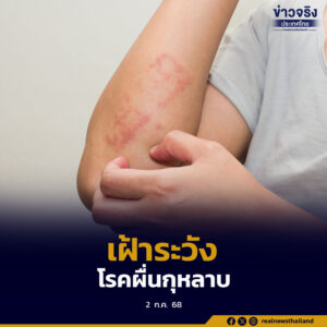 เตือนประชาชนให้เฝ้าระวัง “โรคผื่นกุหลาบ” พบบ่อยในช่วงฤดูฝน