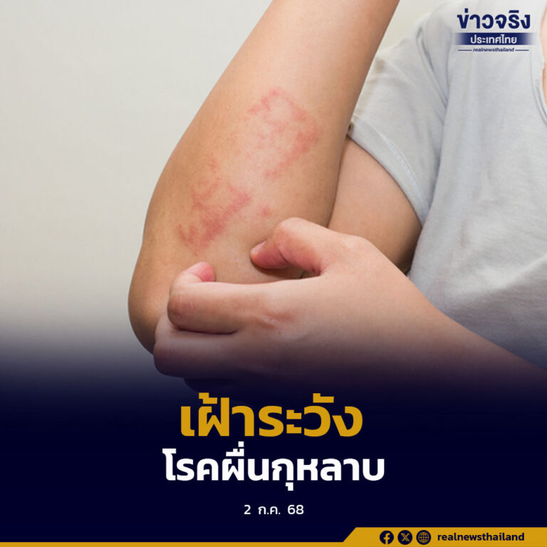 เตือนประชาชนให้เฝ้าระวัง “โรคผื่นกุหลาบ” พบบ่อยในช่วงฤดูฝน