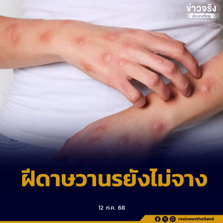 เฝ้าระวังโรคฝีดาษวานรต่อเนื่อง พบผู้ป่วยสะสมปี 2568 แล้ว 40 ราย