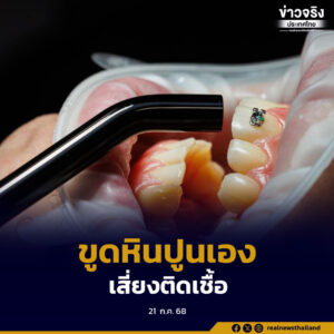 เตือนประชาชนหลีกเลี่ยงการใช้เครื่องขูดหินปูน Ultrasonic ด้วยตนเอง เสี่ยงทำลายฟัน–ติดเชื้อรุนแรง