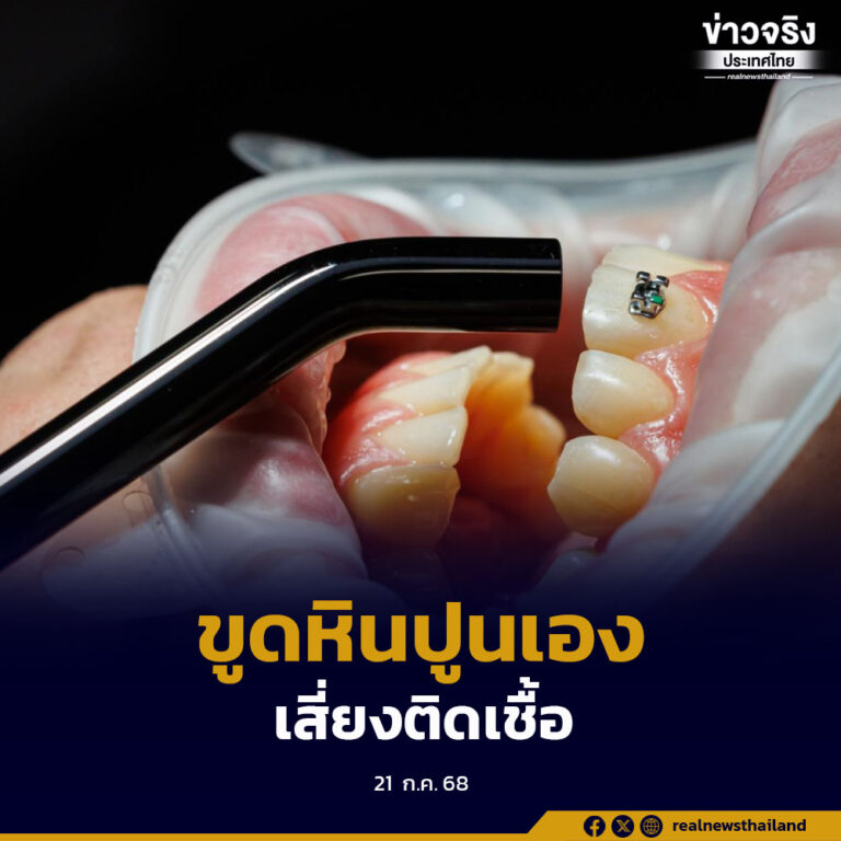เตือนประชาชนหลีกเลี่ยงการใช้เครื่องขูดหินปูน Ultrasonic ด้วยตนเอง เสี่ยงทำลายฟัน–ติดเชื้อรุนแรง