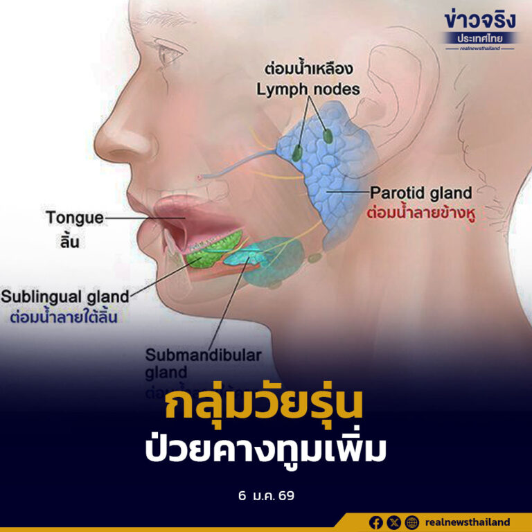 พบผู้ป่วยโรคคางทูมเพิ่มขึ้นในกลุ่มวัยรุ่น ย้ำให้หน่วยงานสาธารณสุขประสานสถานศึกษา ติดตามและดูแลสุขภาพนักเรียนอย่างใกล้ชิด