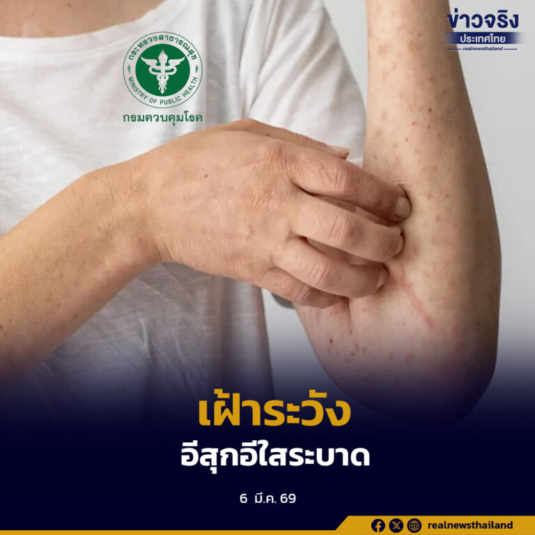 กรมควบคุมโรคเผยต้นปีพบผู้ป่วยโรคอีสุกอีใสสะสมกว่า 10,000 ราย เด็กวัยเรียนป่วยสูงสุด เตือนสถานศึกษาคุมมาตรการป้องกันโรคทางเดินหายใจ ลดการแพร่กระจาย