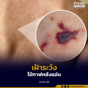 รัฐบาลยกระดับเฝ้าระวังไข้กาฬหลังแอ่น หลังพบระบาดในอังกฤษ