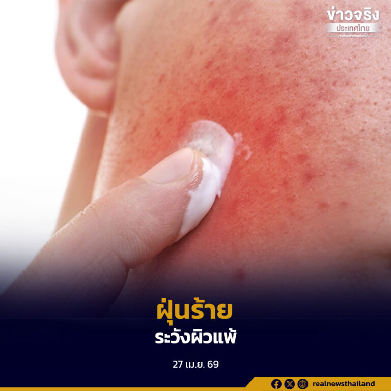 กรมการแพทย์เตือนประชาชนลดสัมผัสฝุ่น PM 2.5 หลังพบส่งผลให้ผิวอักเสบและเสื่อมชราเร็วกว่าปกติ