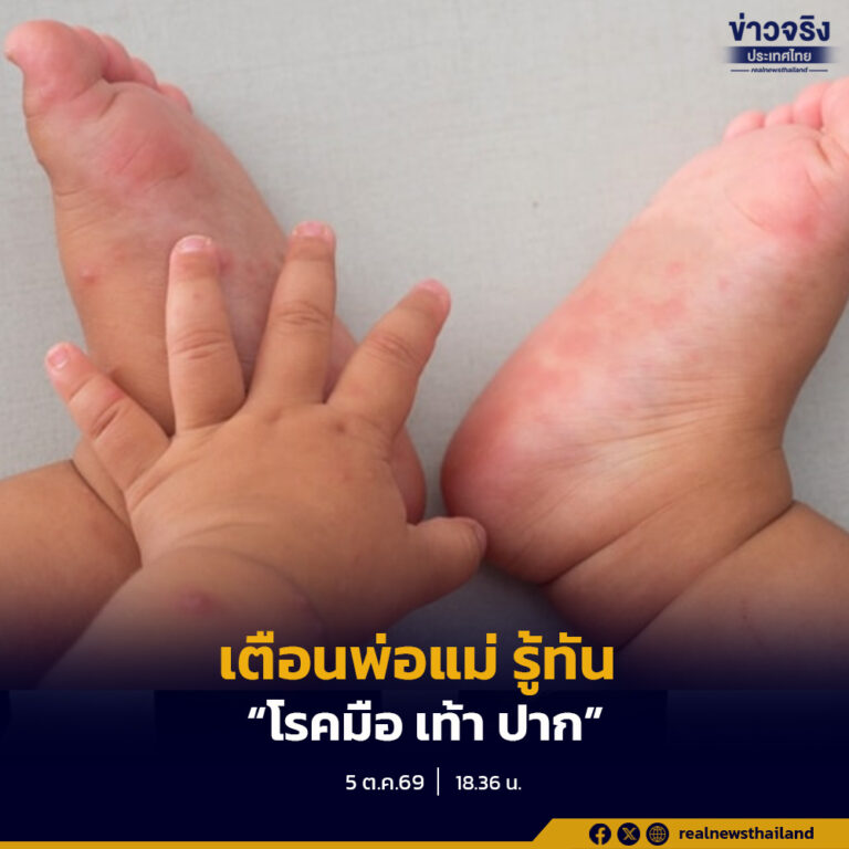 กรมควบคุมโรคเตือนผู้ปกครอง ครู และผู้ดูแลเด็ก เฝ้าระวัง “โรคมือ เท้า ปาก” ซึ่งพบได้บ่อยในเด็กเล็ก แนะคัดกรองก่อนเข้าเรียน แยกเด็กป่วยออกจากผู้อื่น และให้เด็กหยุดเรียน 5 วันทำการหรือตามอาการ