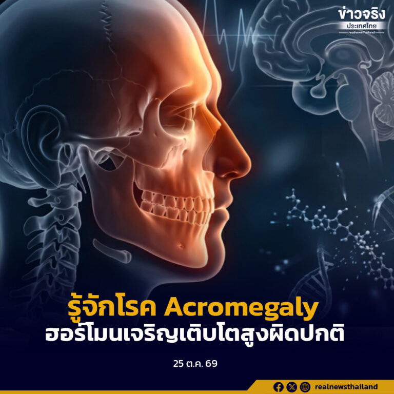 โรงพยาบาลราชวิถี กรมการแพทย์ ชวนรู้จักโรค Acromegalyภาวะฮอร์โมนการเจริญเติบโตสูงผิดปกติในวัยผู้ใหญ่ สังเกตอาการก่อนเกิดภาวะแทรกซ้อน