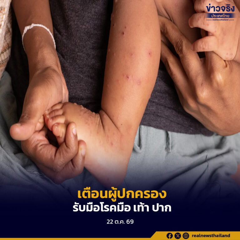 สถาบันสุขภาพเด็กแห่งชาติมหาราชินี กรมการแพทย์ เตือนผู้ปกครองเฝ้าระวังโรคมือ เท้า ปาก ซึ่งพบมากขึ้นในช่วงฤดูฝนและเปิดภาคเรียน โดยเฉพาะเด็กอายุต่ำกว่า 5 ปี ส่วนใหญ่หายเองได้ใน 1 สัปดาห์ หากพบอาการผิดปกติให้รีบพาไปโรงพยาบาล